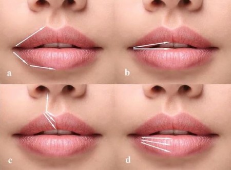 types lip gel injection models 2