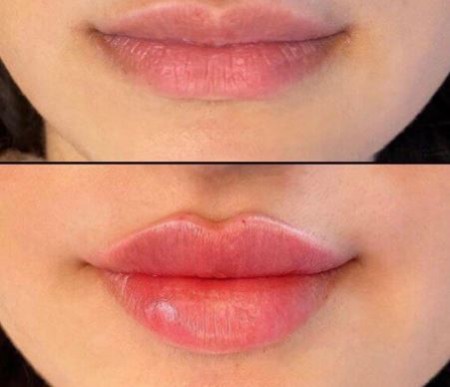 types lip gel injection models 4