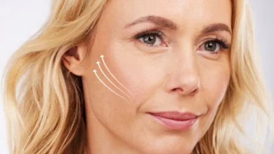 Cheek Lift cosmetic surgery 4