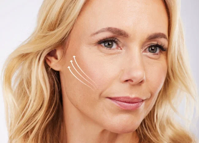Cheek Lift cosmetic surgery 4