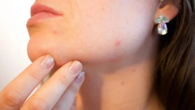 Epidermoid cysts Symptoms and causes 8