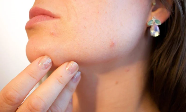 Epidermoid cysts Symptoms and causes 8