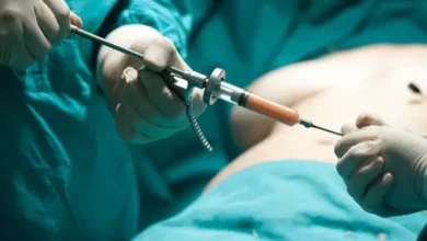 brazilian butt lift 2