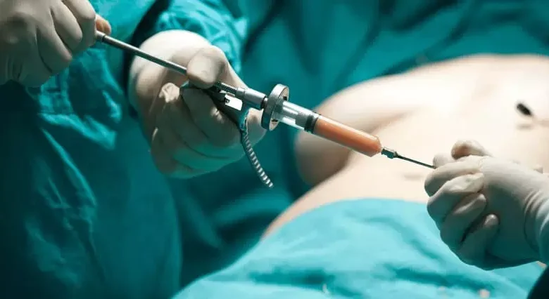 brazilian butt lift 2