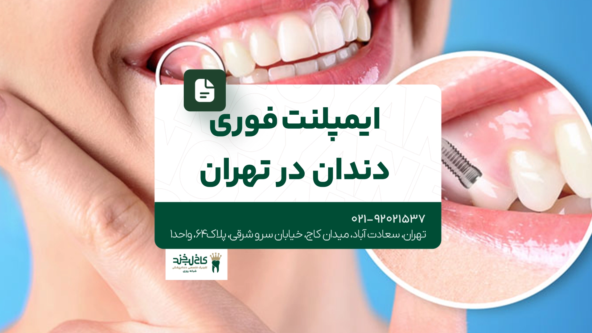 ایمپلنت فوری دندان در تهران