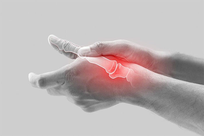 de quervains tendinosis 3